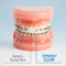 OrthoDots CLEAR – Moisture Activated, Dental Wax Alternative for Pain Caused by Braces, Clear Aligner Trays and other Orthodontic Appliances. OrthoDots Stick Better and Stay on Longer that Dental Wax.