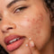 Dermalogica Clear Start Post-Breakout Fix 15ml